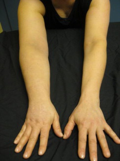 Kinetic Neuro Rehab Deva - Limfedem după mastectomie