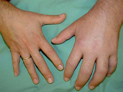 Kinetic Neuro Rehab Deva - Sindromul de durere regională complexă